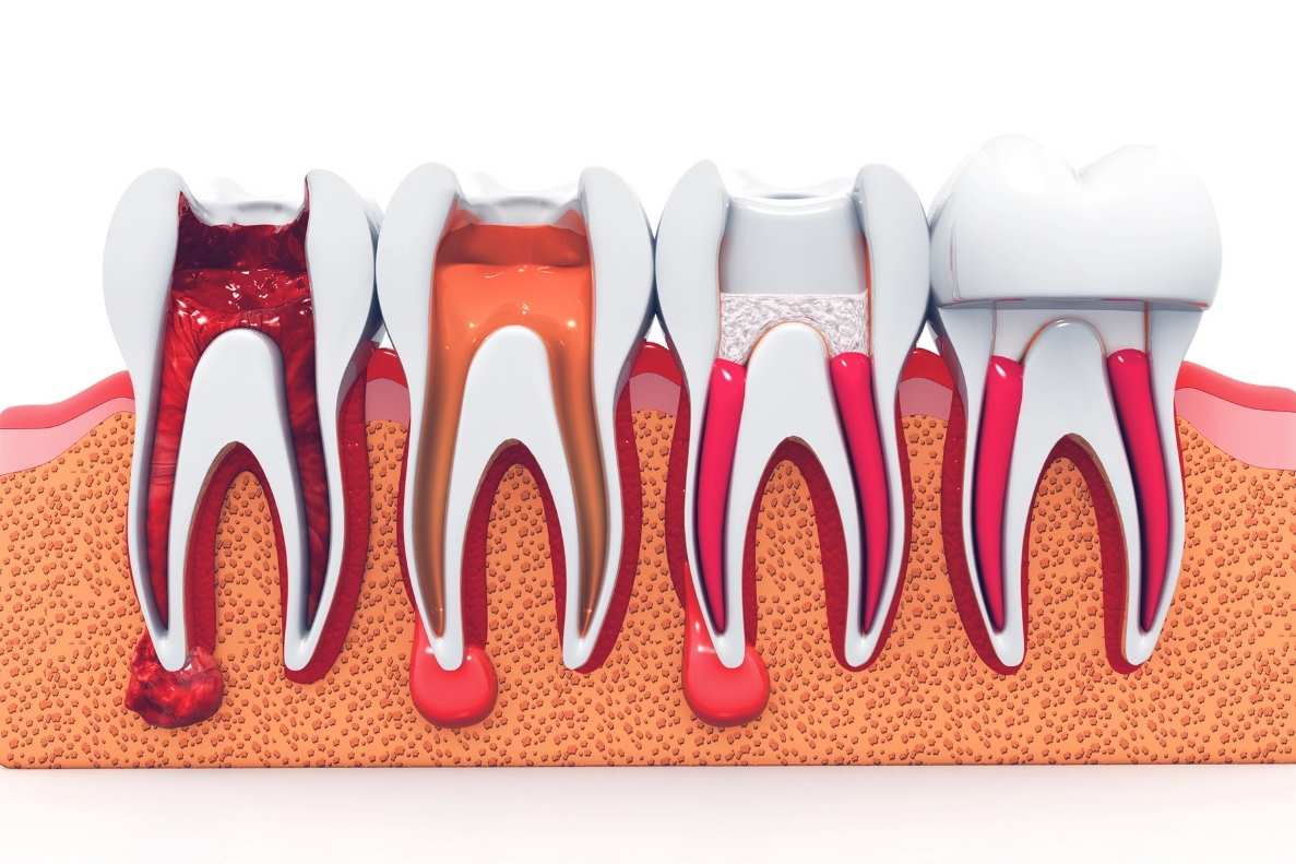 what not to eat after root canal